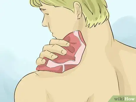 Image titled Remove a Hickey Step 2