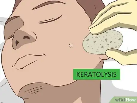 Image titled Remove Facial Warts Step 9