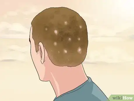 Image titled Diagnose Scalp Psoriasis Step 14