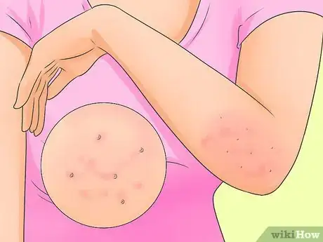 Image titled Cure Scabies Step 1