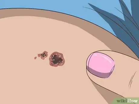 Image titled Recognize Melanoma Step 10