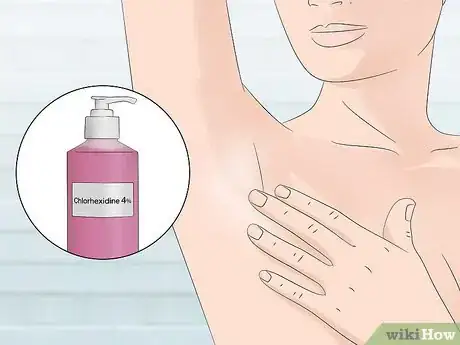 Image titled Stop Armpit Pimples Step 2