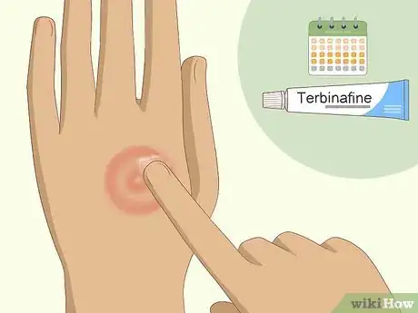 Image titled Get Rid of Ringworm Naturally Step 4