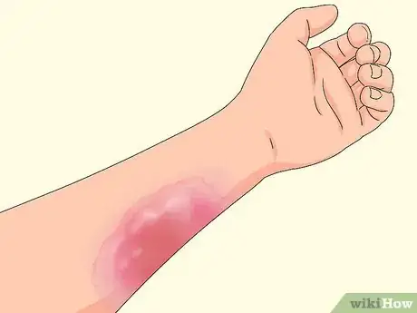 Image titled Determine if a Burn Is Infected Step 2