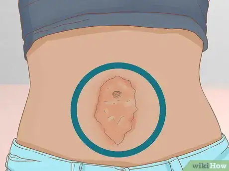 Image titled Clean Your Belly Button Step 6