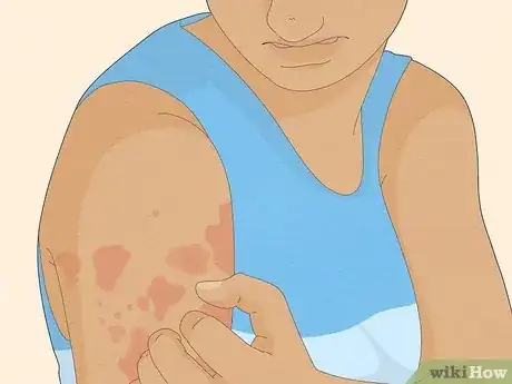 Image titled Know if Skin Barrier Is Damaged Step 3