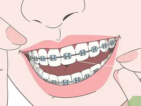 Image titled Eat Food With New or Tightened Braces Step 10