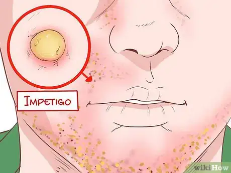 Image titled Identify Symptoms of MRSA Step 9