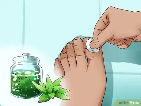 Image titled Use Herbs for Sprains and Bruises Step 7