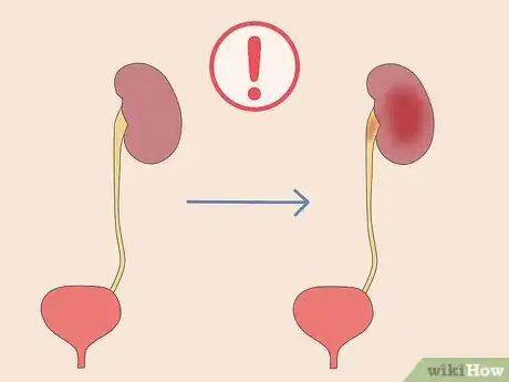 Image titled Donate Your Kidney Step 6