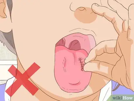 Image titled Stop Tongue Bleeding Step 15