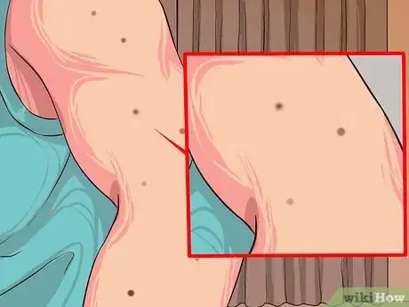 Image titled Perform Melanoma Skin Checks Step 8