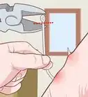 Remove a Fishhook from Skin