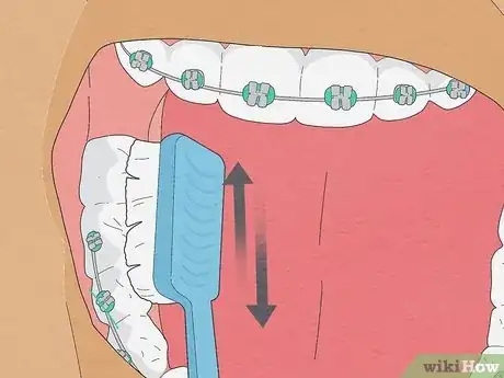 Image titled Brush Your Teeth With Braces On Step 3