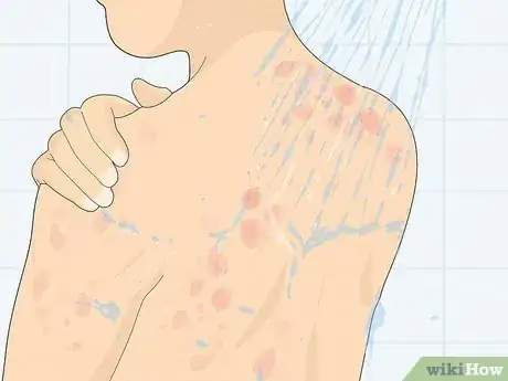 Image titled Recognize Hives (Rash) Step 10