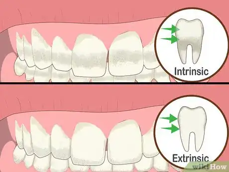 Image titled Protect Gums During Teeth Whitening Step 2