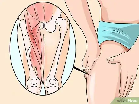 Image titled Know if You Have a Hernia Step 23