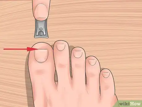 Image titled Tell if You Have an Ingrown Toenail Step 10