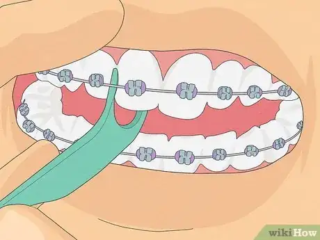 Image titled Brush Your Teeth With Braces On Step 8