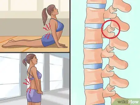 Image titled Determine the Cause of Lower Back Pain Step 8