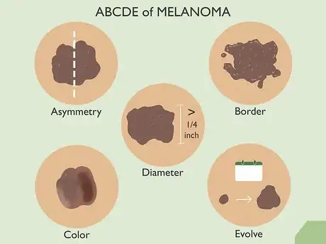 Image titled Check for Skin Cancer Step 3