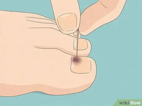 Image titled Remove a Dead Toenail Step 4