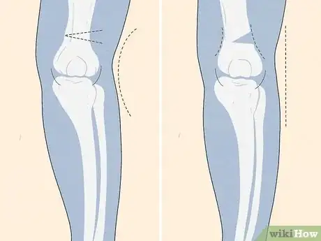 Image titled Fix Knock Knees Step 13