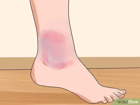 Image titled Know if You've Sprained Your Ankle Step 3