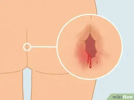 Image titled Recognize Chlamydia Symptoms (for Men) Step 6