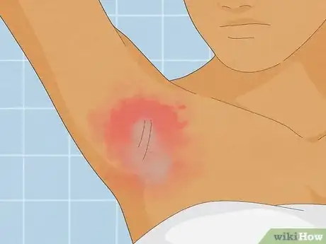 Image titled Heal Armpit Rash Step 5