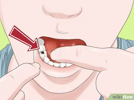 Image titled Know if Your Dental Fillings Need Replacing Step 5