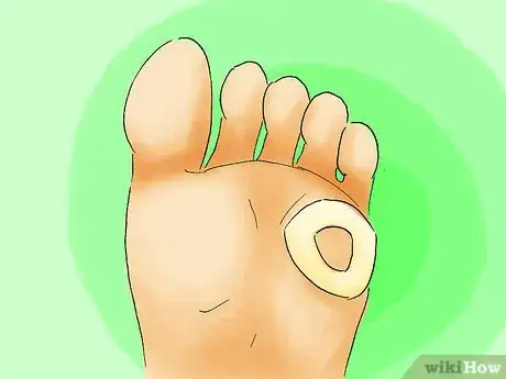 Image titled Remove Corns from Your Toes Step 07