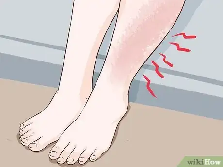 Image titled Use Supplements to Avoid Deep Vein Thrombosis (DVT) Step 12