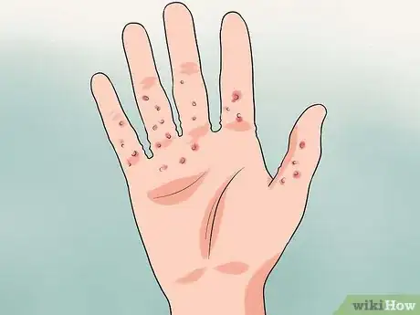 Image titled Diagnose Scabies Step 4