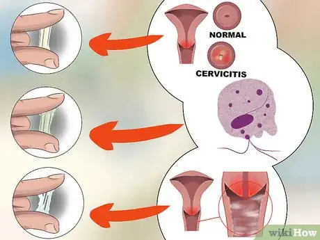 Image titled Diagnose Vaginal Discharge Step 6