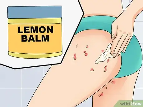 Image titled Ease Herpes Pain with Home Remedies Step 14