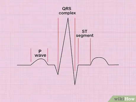 Image titled Calculate Heart Rate from ECG Step 1