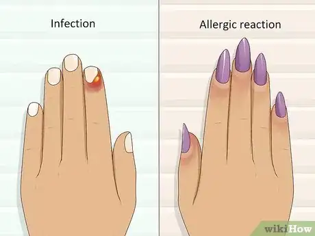 Image titled Stop Itchy Cuticles Step 4