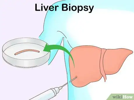 Image titled Test Liver Function Step 10