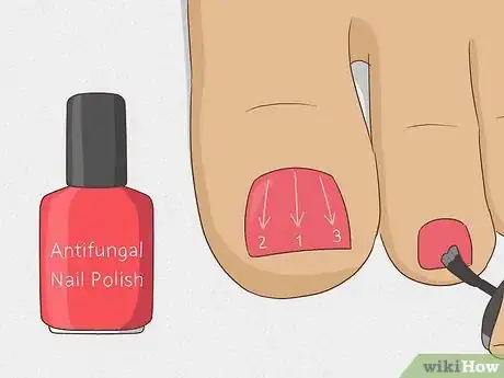 Image titled Hide Nail Fungus Step 4