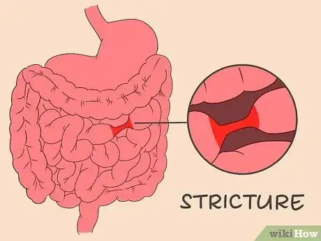 Image titled Treat Diverticulitis Step 12