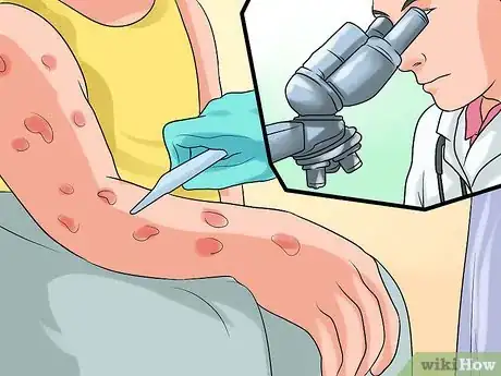 Image titled Diagnose Scabies Step 9