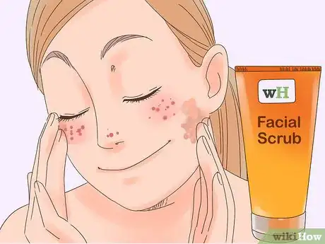 Image titled Remove the Redness of a Pimple Step 19