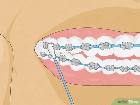 Image titled Temporarily Fix a Loose Wire on Your Braces Step 3