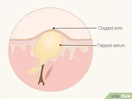 Image titled What Do Clogged Pores Look Like Step 2