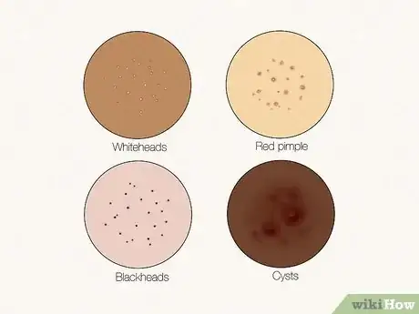 Image titled What Do Clogged Pores Look Like Step 1