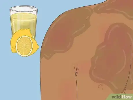 Image titled Remove Sunburn Patches (for Indian Skin Types) Step 1