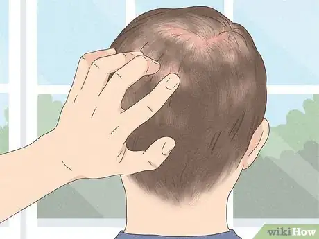 Image titled Know if You Have Male Pattern Baldness Step 4