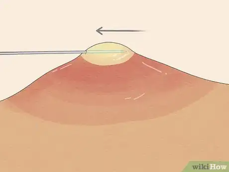 Image titled Pop a Pimple Step 14