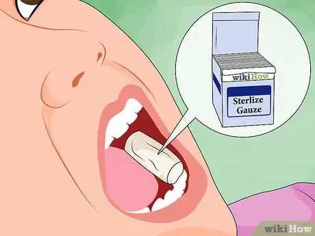 Image titled Ease Wisdom Tooth Pain Step 12